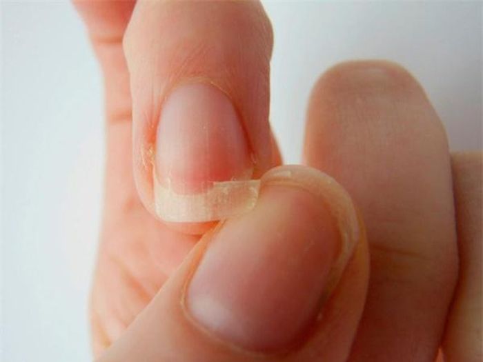 Móng tay bị gãy, lật ngược phạm vào da tay đau nhức.