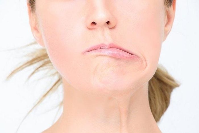 Méo miệng do liệt dây thần kinh số VII