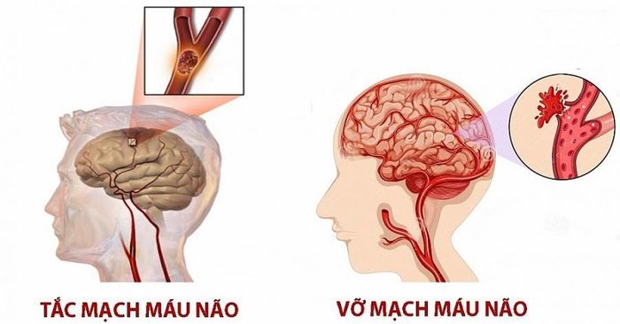 2 thể lâm sàng của bệnh tai biến mạch máu não