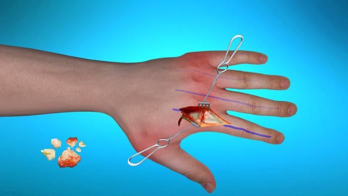 Điều trị phong thấp dạng thấp bằng phẫu thuật với mục đích sửa chữa các khớp bị hư hỏng và xảy ra biến dạng nặng nề - Ảnh Internet