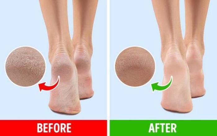 Giảm bớt tình trạng khô chân: Nếu bạn bị khô chân hoặc nứt gót chân, đi tất để giữ ẩm bàn chân kết hợp thoa dầu dưỡng thể hoặc kem dưỡng ẩm trước khi đi ngủ sẽ có tác dụng rất tốt. Bạn cũng có thể sử dụng phương pháp này trên tay của mình.
