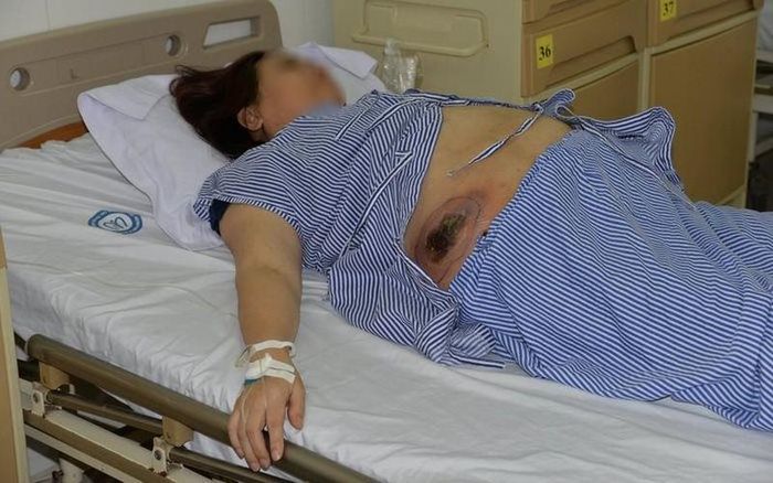 Bệnh nhân điều trị tại Bệnh viện Nội tiết Trung ương.