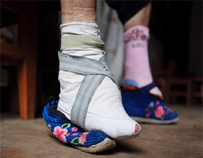  10. Bó chân: Chỉ khi có được đôi chân nhỏ nhắn, thon thả thì các thiếu nữ Trung Quốc mới mong lấy được chồng giàu sang. Trào lưu này thịnh hành gần 1.000 năm trước rồi bị hủy bỏ bởi tác hại lâu dài đối với sức khỏe. 