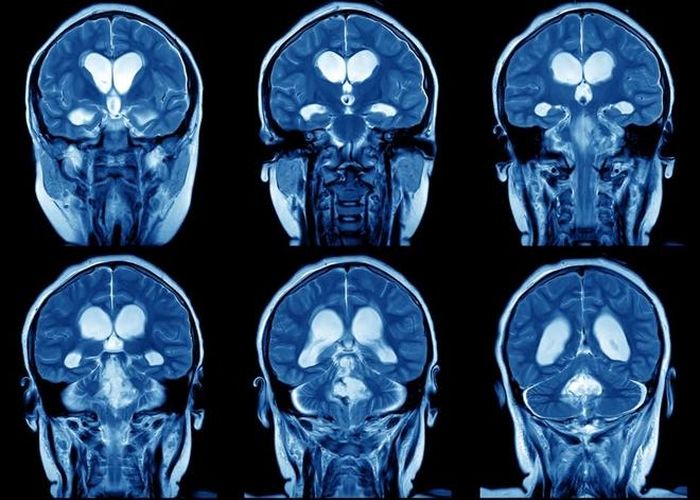 Tính mềm dẻo não bộ chỉ khả năng thích ứng của não sau trải nghiệm hoặc tổn thương.