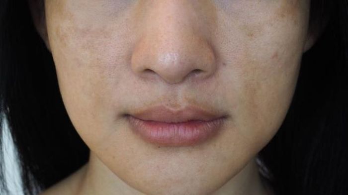 Da khô, xỉn màu: Vitamin C rất quan trọng với việc sản xuất collagen trong cơ thể. Nếu cơ thể không nhận đủ vitamin C, da của bạn sẽ bị khô, xỉn màu và nhăn nheo.