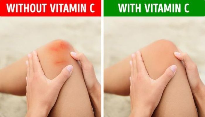 Dễ bị bầm tím: Nếu da bạn dễ bị bầm tím, hoặc các vết thương trên da mất nhiều thời gian để chữa lành thì rất có thể, cơ thể bạn đang thiếu vitamin C. Điều bạn cần làm lúc này là cố gắng bổ sung nhiều rau củ và trái cây họ cam, quýt.