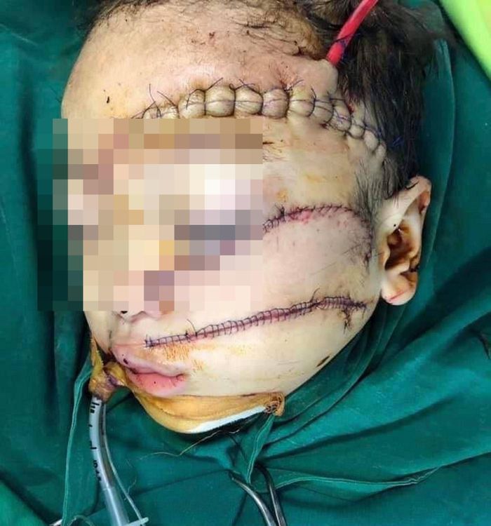 Bé K đang điều trị tại bệnh viện