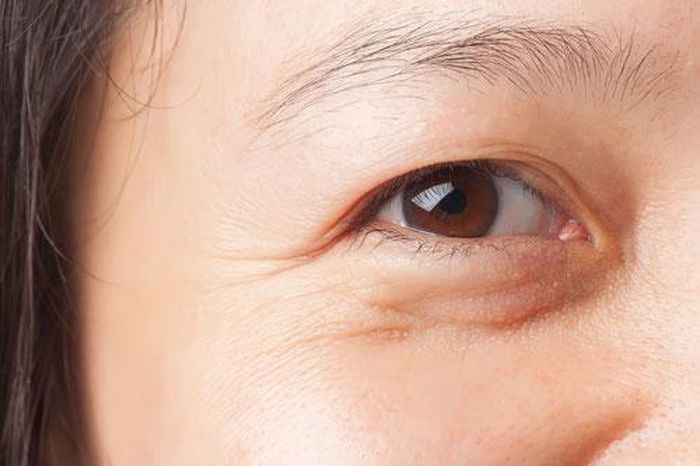 Bọng mắt gây ảnh hưởng đến thẩm mỹ.