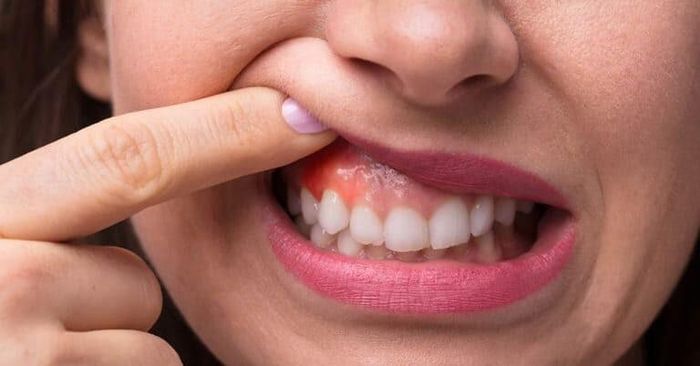 Viêm lợi có thể gây đau răng