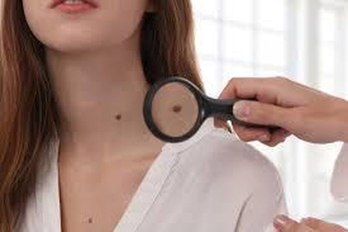 Không tự ý xóa nốt ruồi.