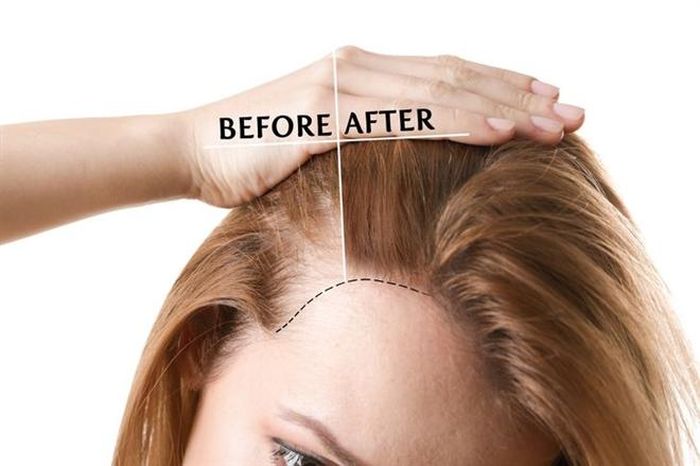 Tóc dày hơn: Tiêu thụ lượng đường quá lớn sẽ khiến tóc dễ bị gãy rụng và mỏng. Điều này xảy ra khi lượng glucose tăng cao, làm mất cân bằng các hormone như insulin và steroid. Tuy nhiên, tình trạng này sẽ được giải quyết nếu bạn có chế độ ăn uống hợp lý, khoa học.