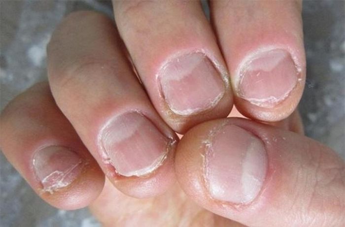 Móng nham nhỡ gặp trong bệnh lý nấm móng.