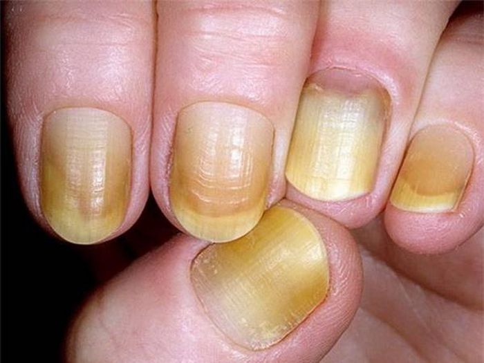 Móng vàng là biểu hiện thường thấy ở những người bị nấm móng.