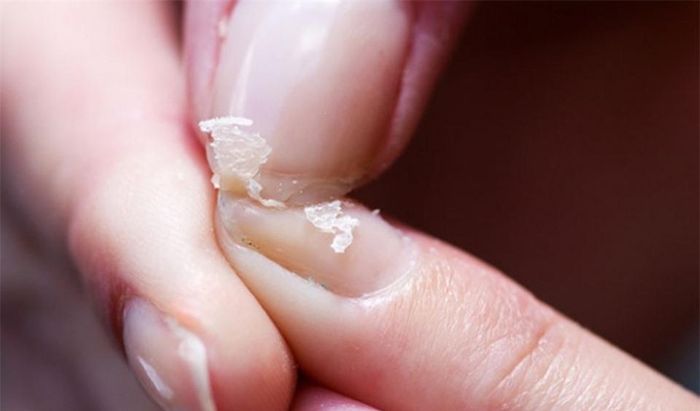 Móng tay dễ gãy do tiếp xúc nhiều với hóa chất, nước sơn hoặc là dấu hiệu lão hóa.