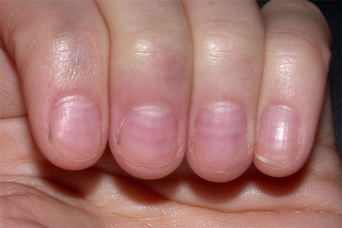 Móng tay sọc trắng ngang có thể là dấu hiệu cơ thể đang thiếu kẽm hoặc protein.