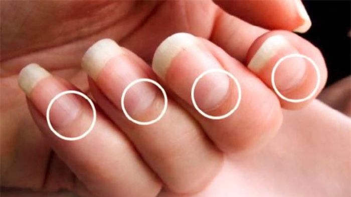 Móngcó hình bán nguyệt kích thước lớn hơn bình thường thì có thể bạn đang gặp vấn đề về gan.