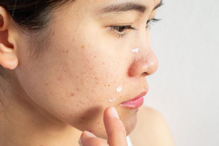 Không rửa mặt sẽ dẫn đến nhiều vấn đề da không mong muốn như mụn, kích ứng, da sần sùi. Ảnh: Hypebae.