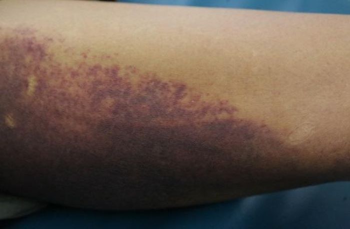 Tình trạng xuất huyết cải thiện sau 5 ngày điều trị