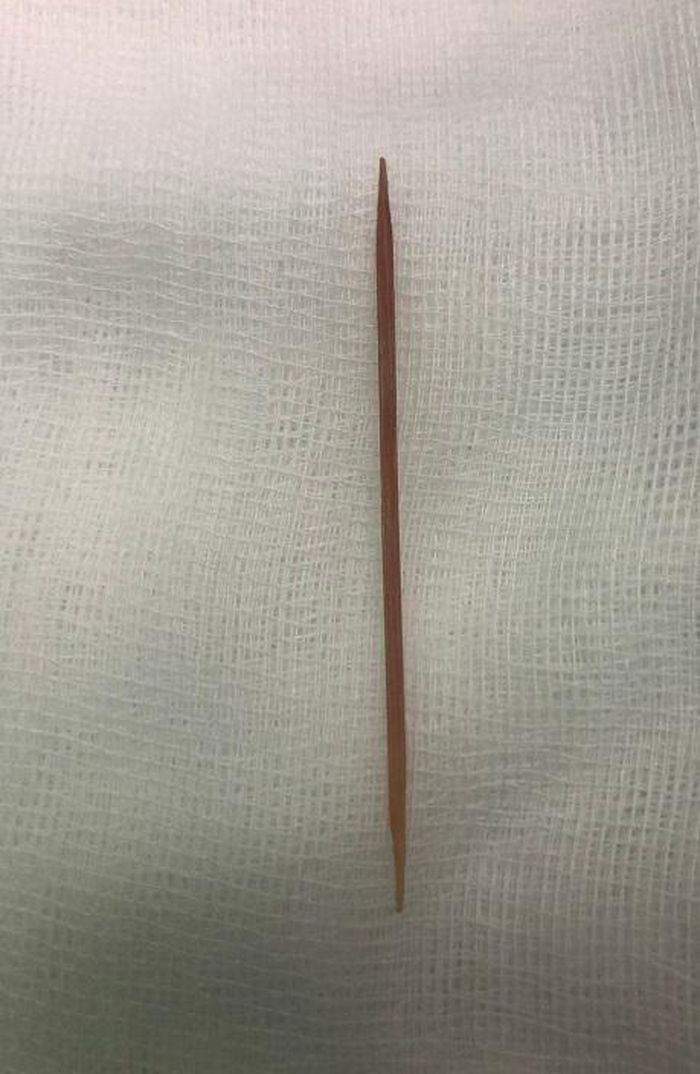 Chiếc tăm tre dài 5 cm sau khi được phẫu thuật