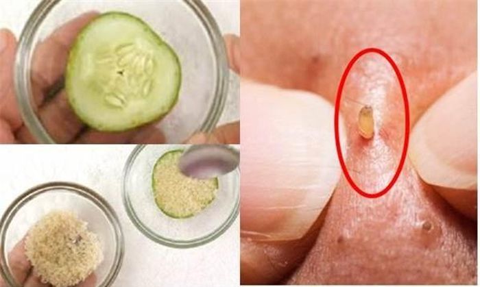 Dùng dưa chuột giúp bạn trị mụn đầu đen hiệu quả.