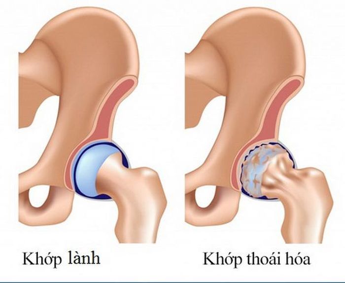 Thoái hóa khớp háng gây đau và làm biến đổi cấu trúc của khớp.