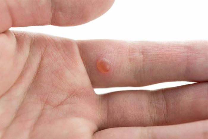 Tiêu diệt mụn cóc: Bạn có thể dán một miếng vỏ chuối vào mụn cóc và để qua đêm. Hãy làm điều này cho đến khi mụn cóc rơi ra. Bạn có thể xử lý mụn cóc nhanh hơn nếu cắt bỏ lớp mụn chết trước khi đắp vỏ chuối lên.