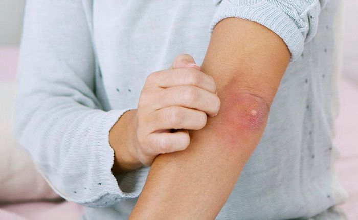 Bóng nước tự miễn khiến người bệnh đau đớn do da nổi bóng nước, lở loét. Ảnh minh họa: Heathline.
