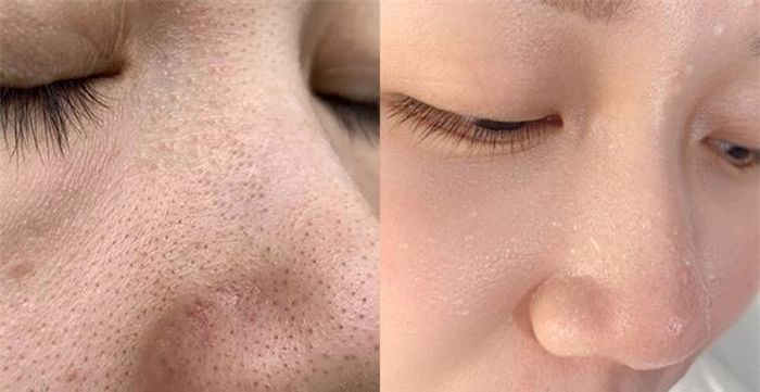Bạn có thể trị mụn đầu đen tại nhà.