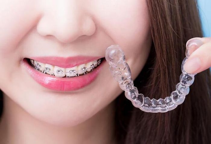 Niềng răng mắc cài hay niềng răng trong suốt tốt nhất? (ảnh minh họa)