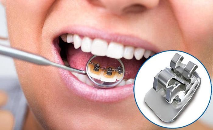 Niềng răng mắc cài mặt trong/mặt lưỡi (ảnh minh họa)