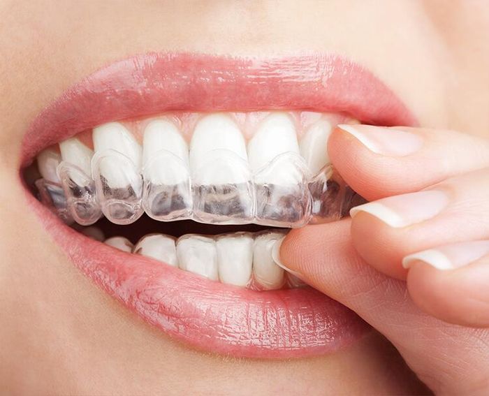 Niềng răng trong suốt Invisalign (ảnh minh họa)