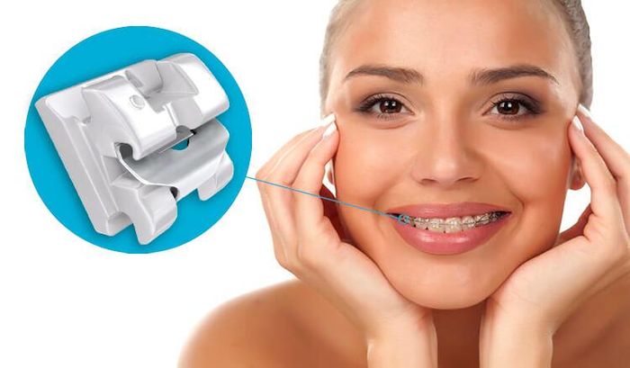Niềng răng mắc cài sứ (ảnh minh họa)