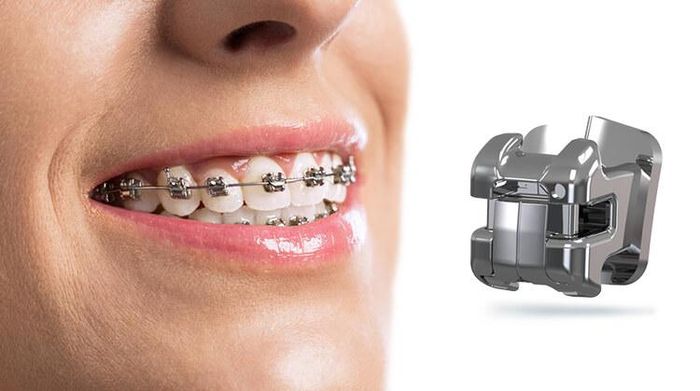 Niềng răng mắc cài kim loại tự động (ảnh minh họa)
