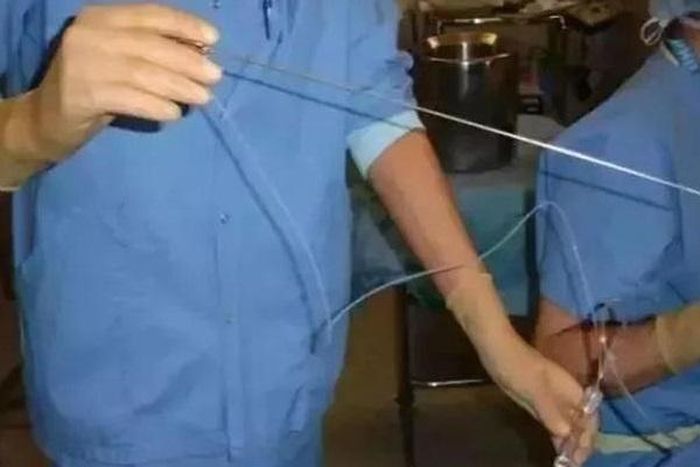 Dụng cụ dùng để hút trứng. Ảnh: Baijiahao