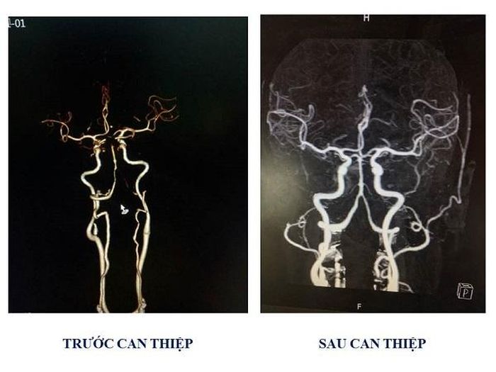 Hình ảnh trước – sau can thiệp tái thông mạch não