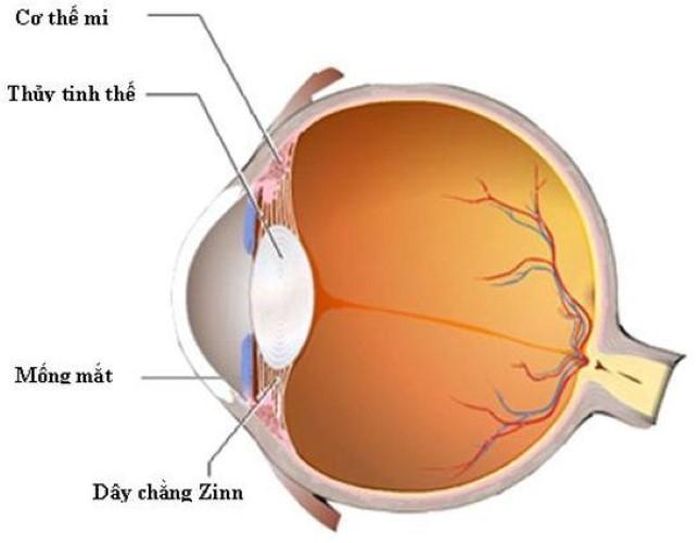 Đục thủy tinh thể.
