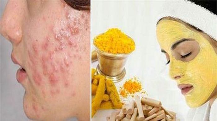 Sử dụng bột nghệ và gỗ đàn hương sẽ cải thiện mụn trứng cá đáng kể.