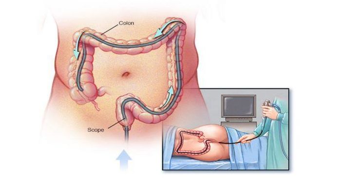 Nội soi đường ruột giúp phát hiện sớm các vấn đề về đường ruột.