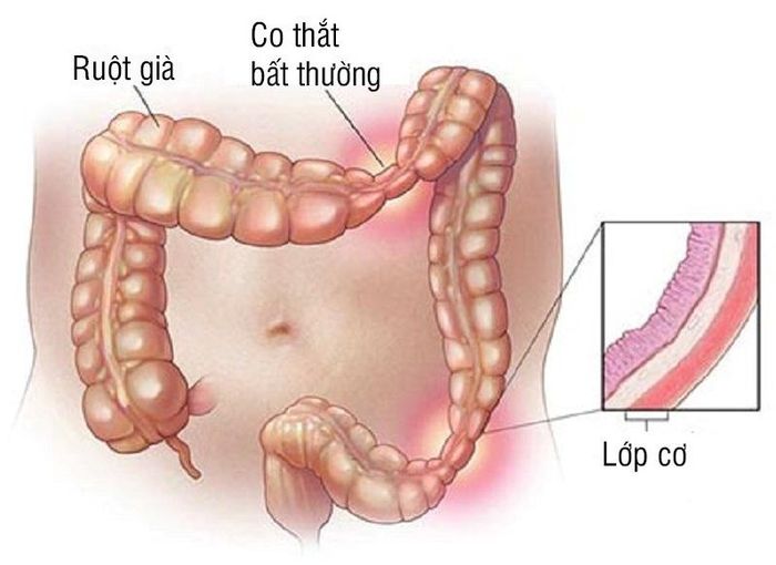 Hội chứng ruột kích thích - một trong những nguyên nhân gây cảm giác đầy bụng.