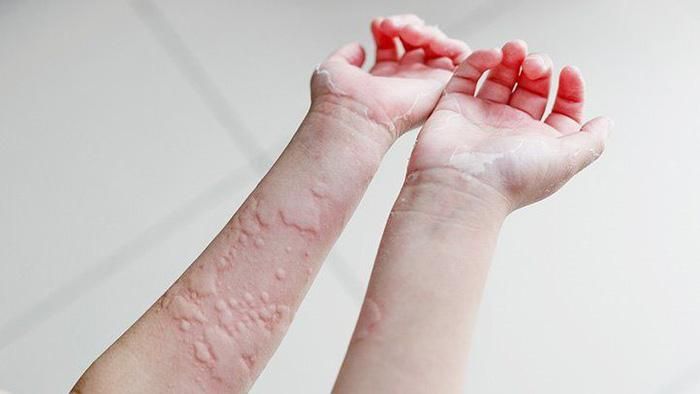 Cần lựa chọn trang phục rộng rãi đem lại hiệu quả che chắn trong mùa hè hiệu quả - Ảnh Internet