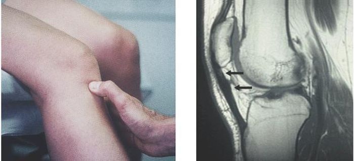 Hình ảnh đứt gân bánh chè trên phim MRI (phải) và dấu hiệu mất liên tục trên lâm sàng (trái)