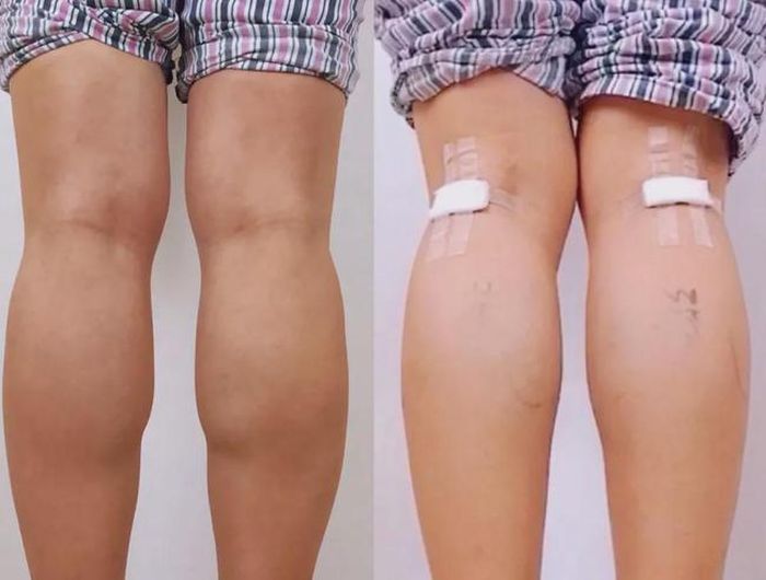 Nhiều người mù quáng tin vào phẫu thuật cắt dây thần kinh để có bắp chân gầy hơn.