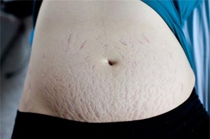 Rất nhiều mẹ bầu bị rạn da trong quá trình mang thai.