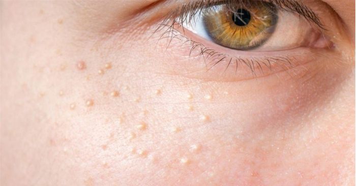 Mụn thịt gây nên tình trạng mất thẩm mỹ.