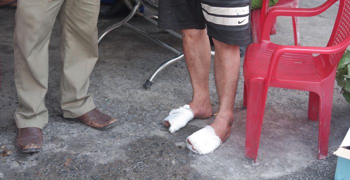  Anh Mạnh bị phỏng nặng ở bàn chân trong lúc cố gắng đưa vợ và con trai ra bên ngoài.. Ảnh: Toàn Nguyễn. 