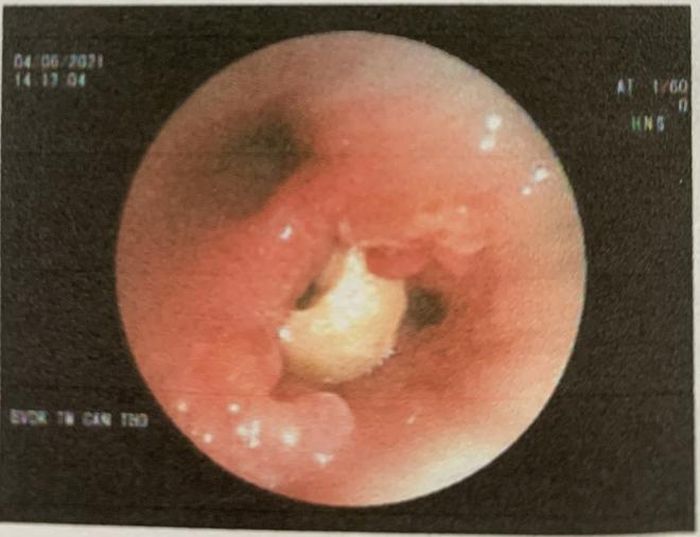 Hình ảnh hạt đậu phộng trong phổi cụ K.