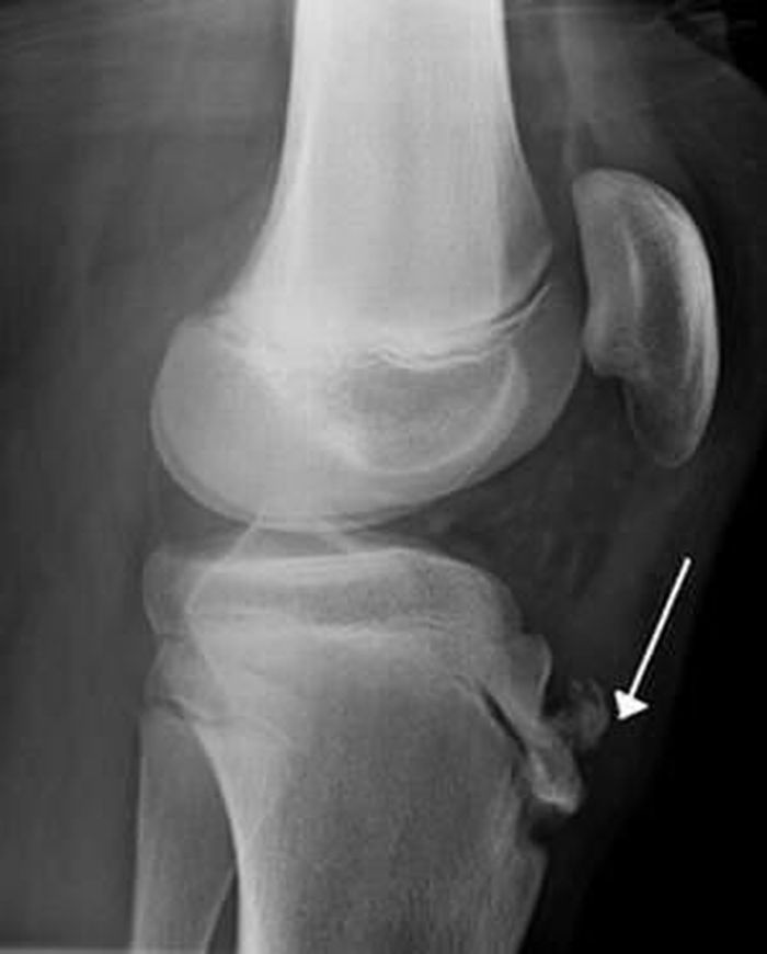 Tổn thương xương chày trên phim Xquang trong bệnh Osgood – Schlatter