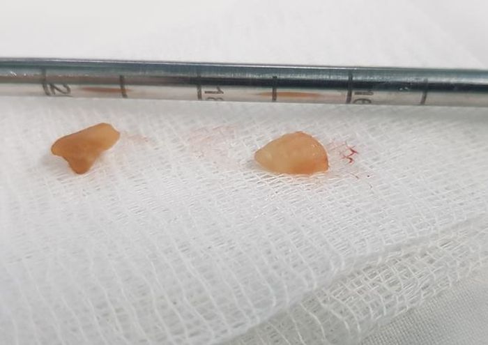 Dị vật là 2 mảnh hạt đậu phộng được lấy ra từ phế quản cháu K.