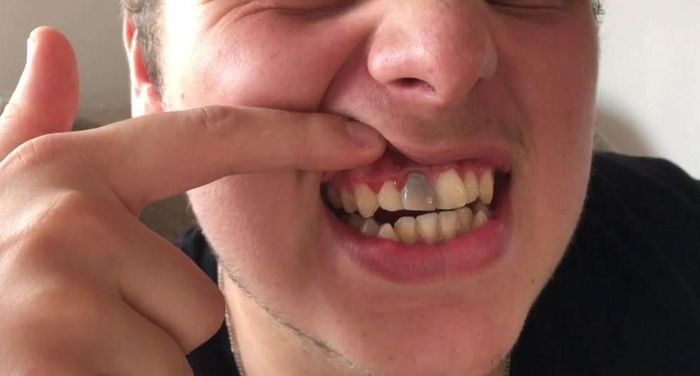 Răng bị xám đen do nhiều nguyên nhân