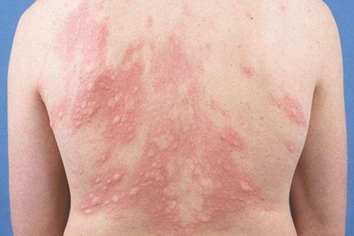 Mề đay có thể do thay đổi thời tiết.